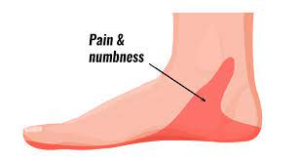 What Is Tarsal Tunnel Syndrome Hurst Podiatry