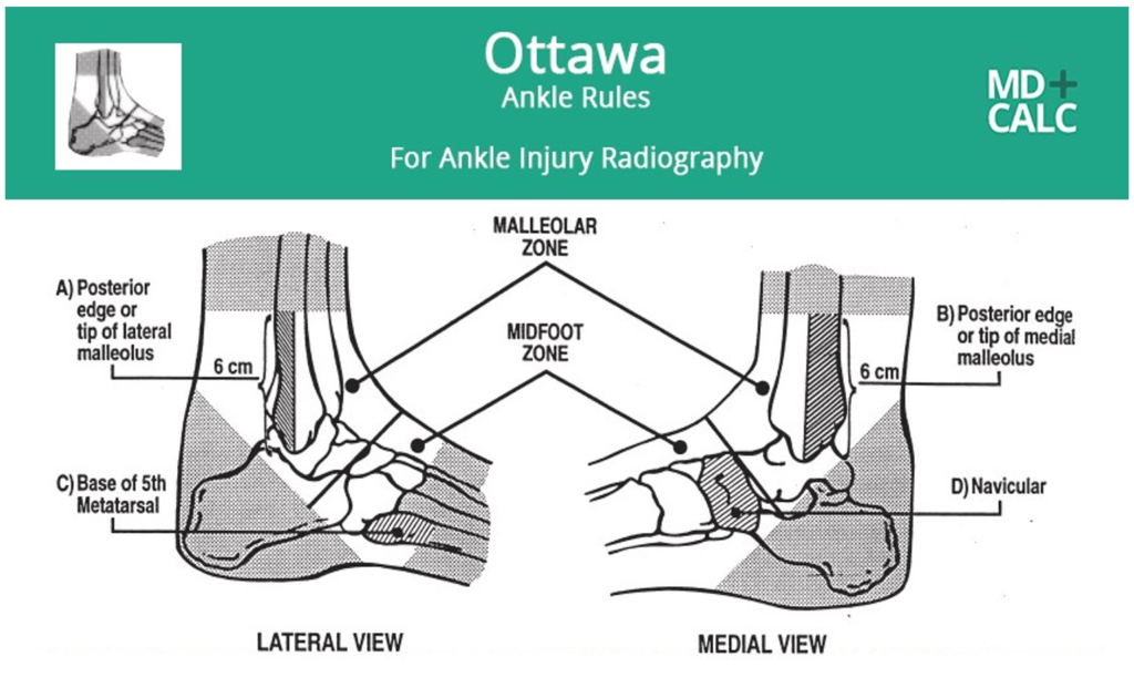 Guide, Physical Therapy Guide to Ankle Sprain
