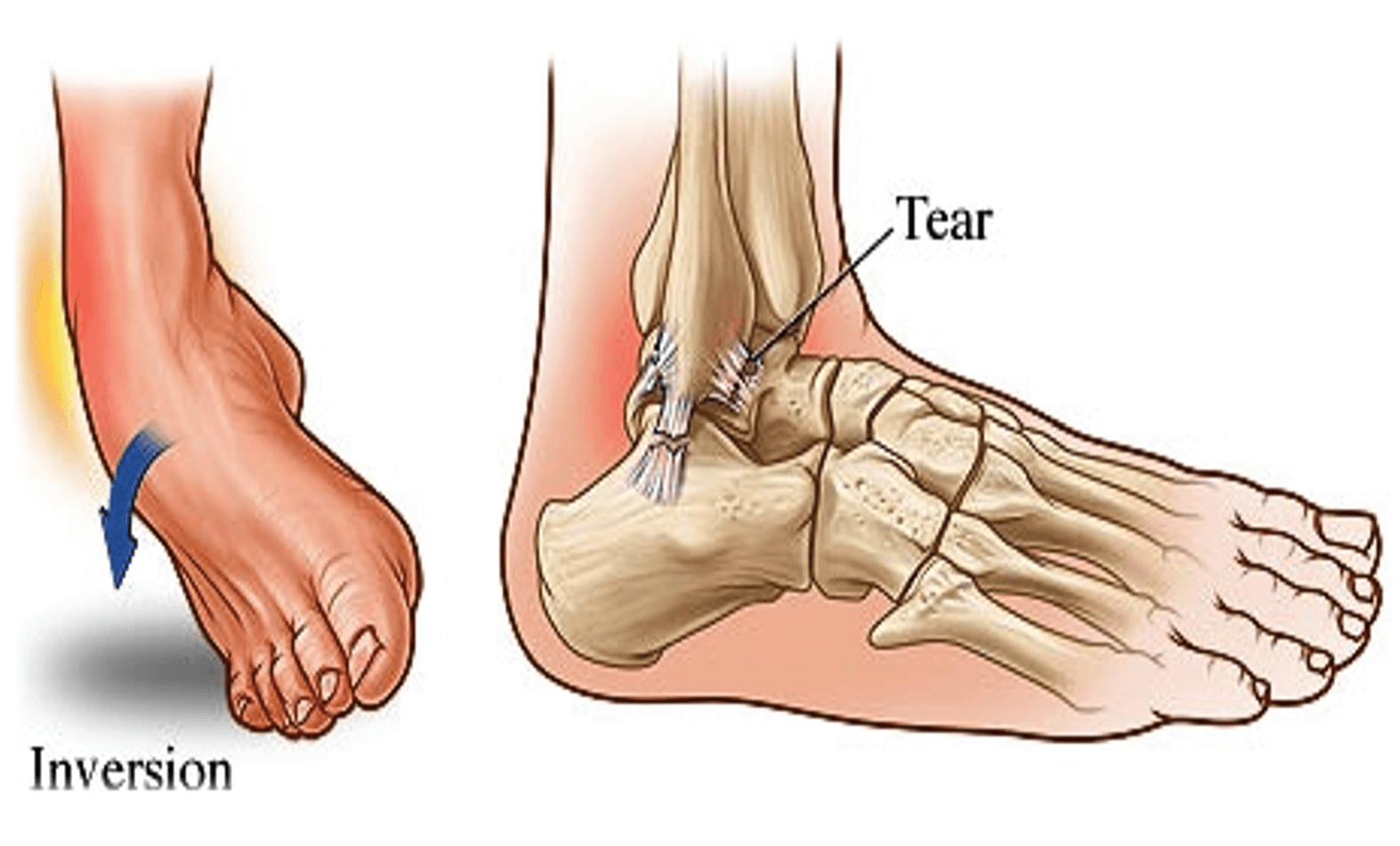 Patient Basics: Ankle Sprain