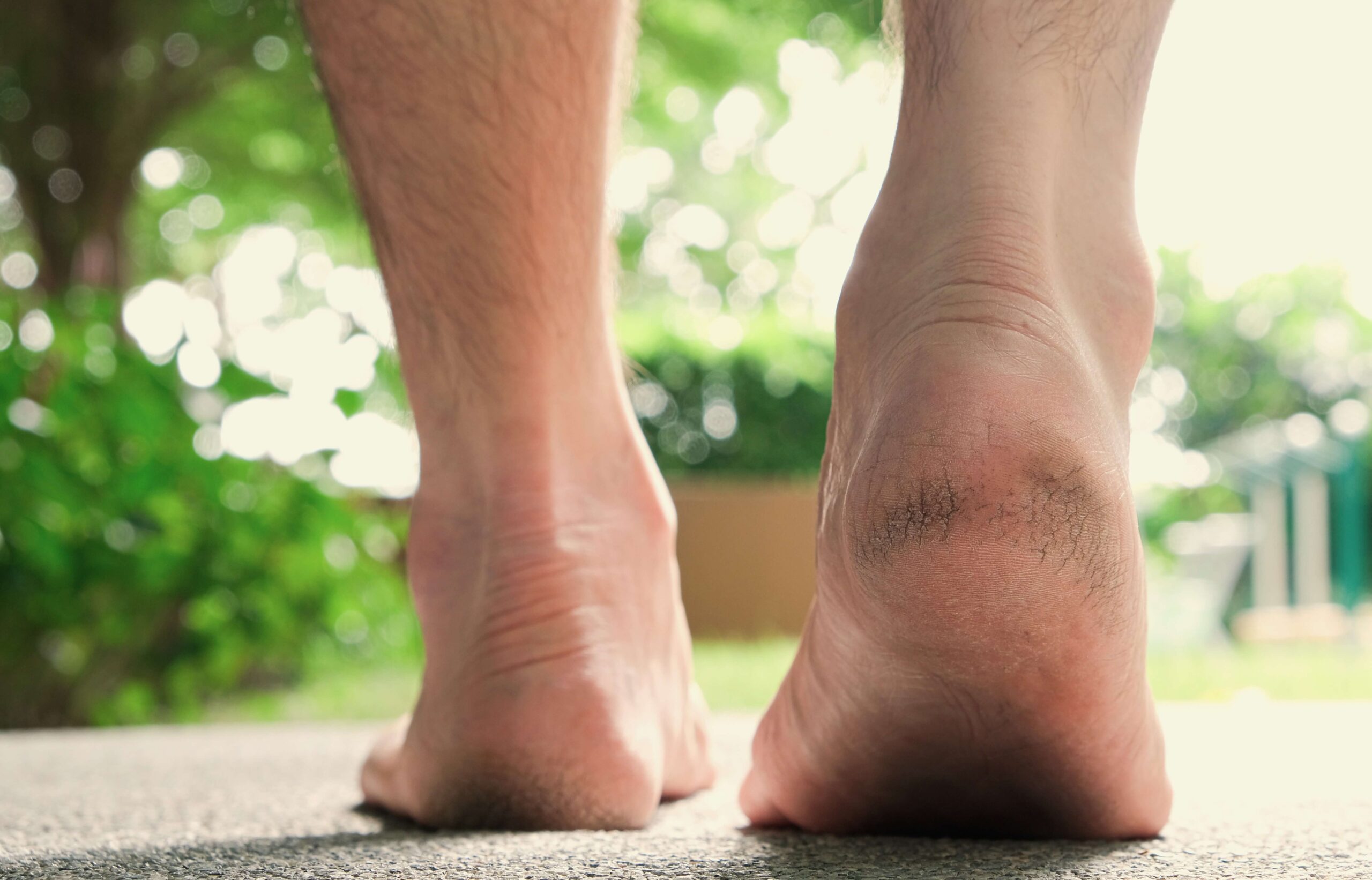 6 Methods To Eliminate Cracked Heels - Skin Beauty